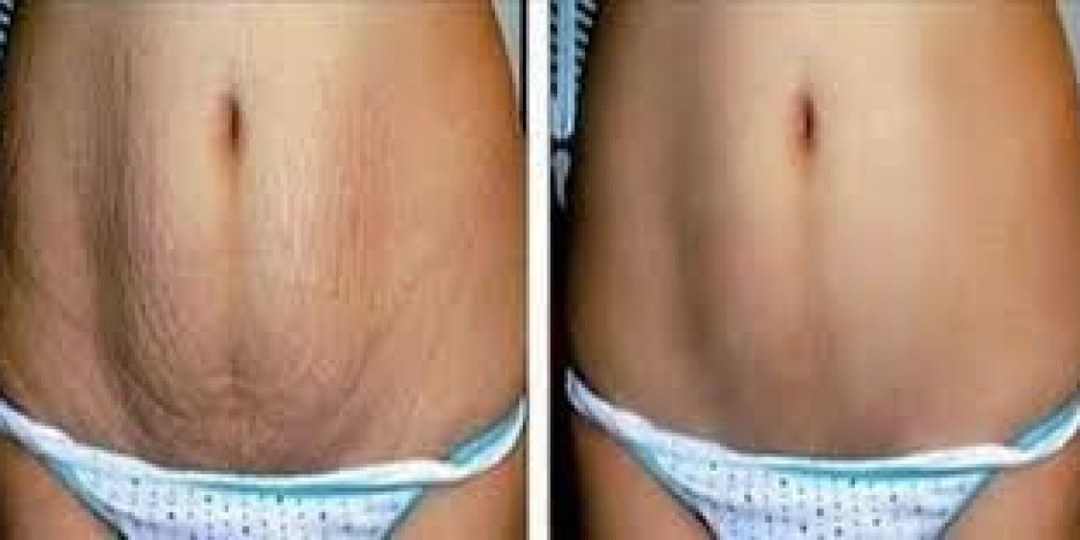 Innovative Stretch Mark Removal Solutions Dubai: Advanced Skin Resurfacing and Restoration