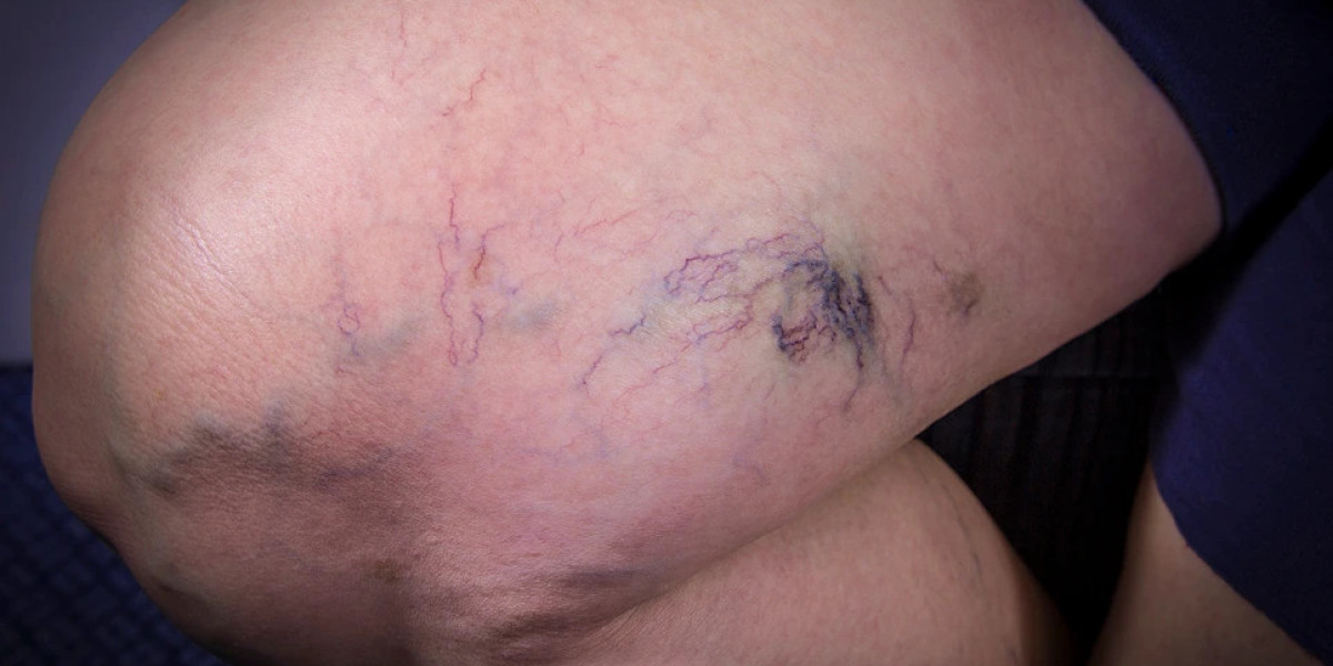 Spider Veins Treatment: What Happens During the Process?