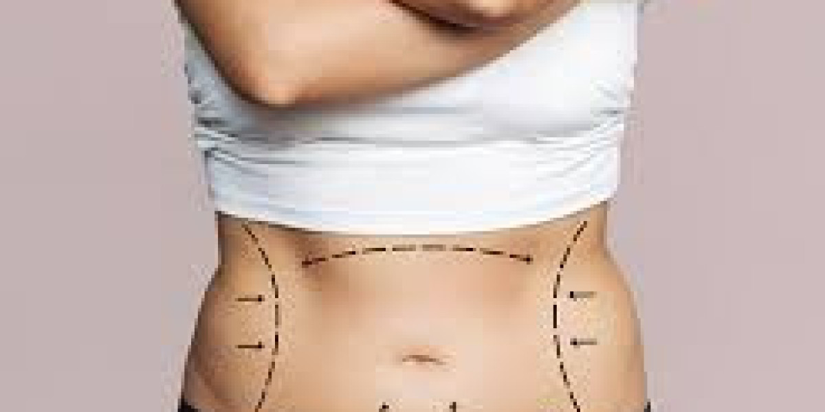 Top-Rated Tummy Tuck Doctors in Dubai for Safe and Effective Procedures