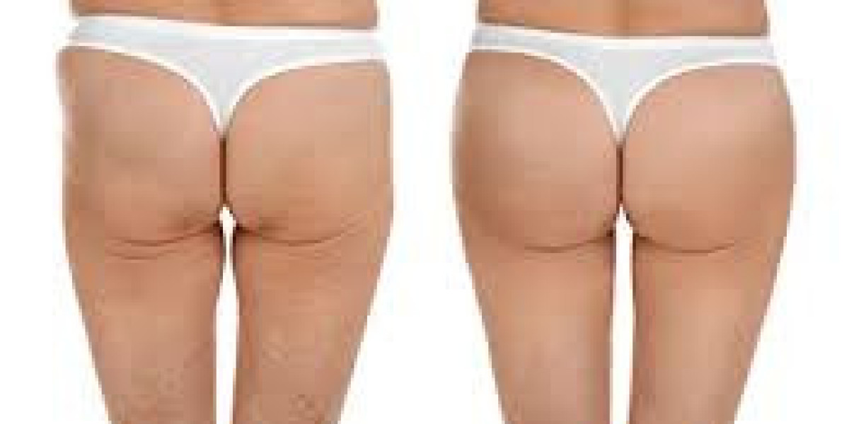 Dubai Cosmetic Surgery for Body Contouring – Modern Solutions for a Sculpted Look
