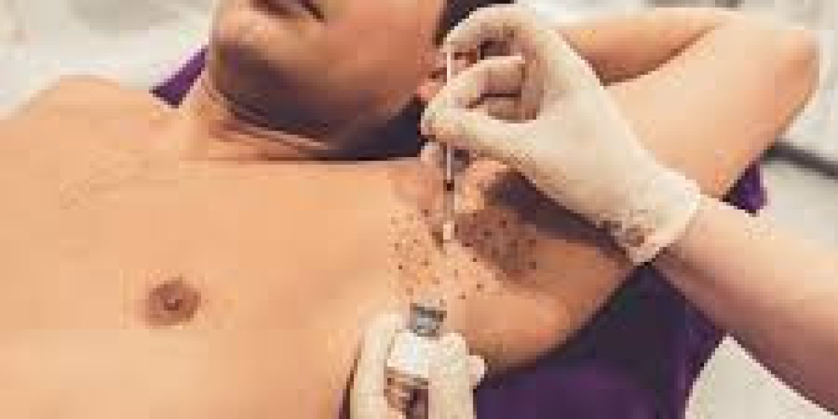 Hyperhidrosis Treatment Techniques Available in Dubai | Effective Excessive Sweating Solutions