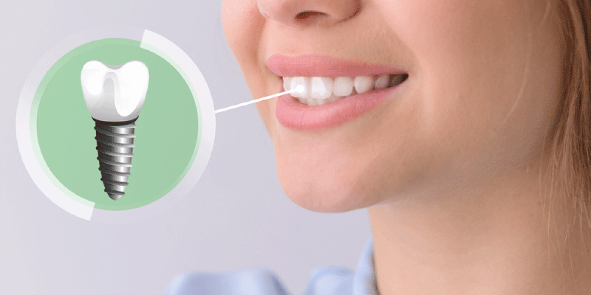 Will Full Mouth Dental Implants Cost Deliver Teeth That Feel Perfect Instantly
