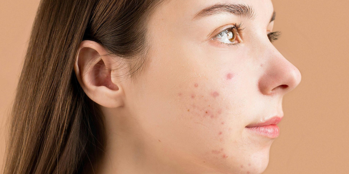 Acne Treatment for Teenagers in Islamabad