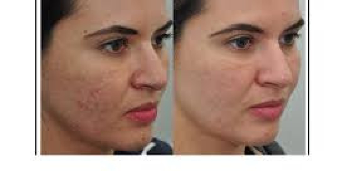 Laser Therapy for Sun Damage Dubai | Skin Rejuvenation and Repair Solutions