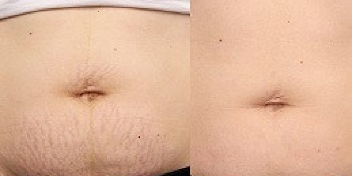 Personalized Treatment Plans for Stretch Marks Dubai – Customized Skin Rejuvenation Solutions