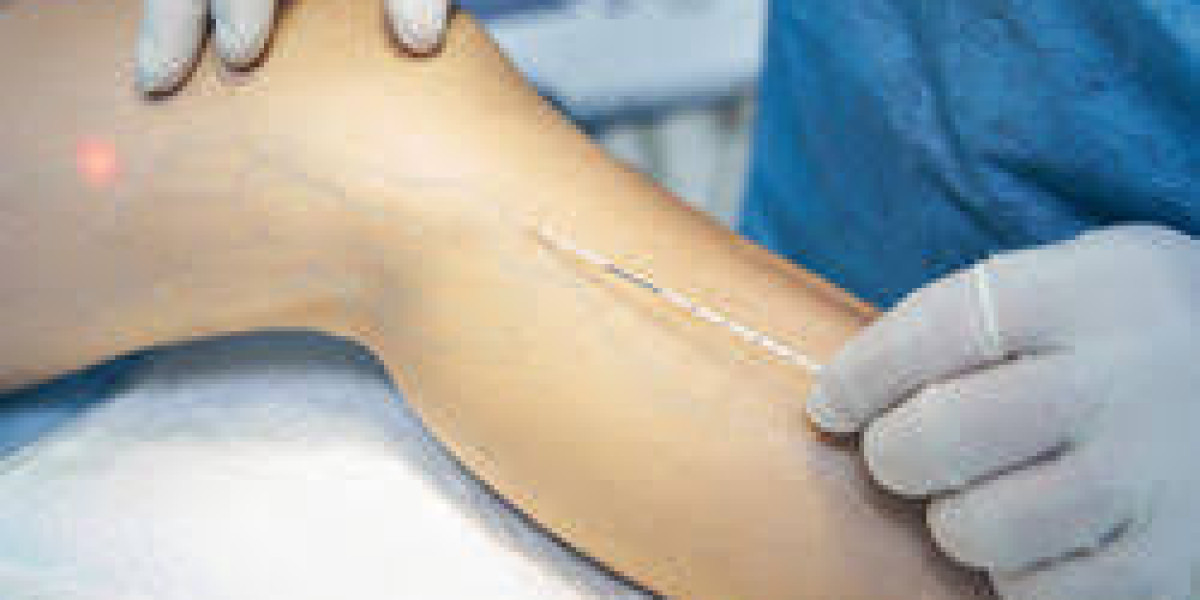 Effective Spider Veins Removal Dubai | Safe & Modern Treatment Options