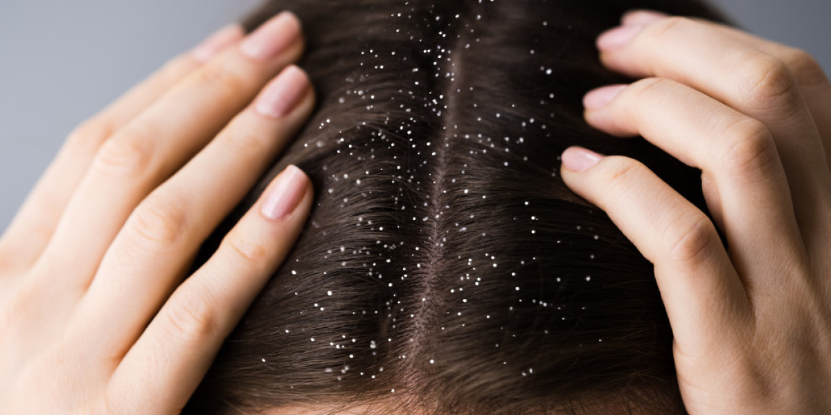 Anti Dandruff and Hair Fall Shampoo for Healthy Scalp