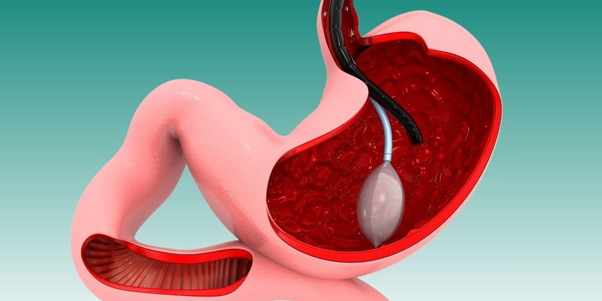 Gastric Balloon Placement: Understanding the Full Process
