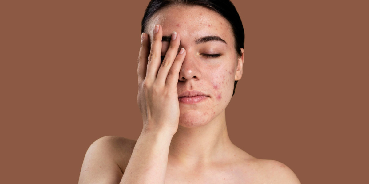 Expensive Branded Serums Treat Acne Scars - Truth or Myth?