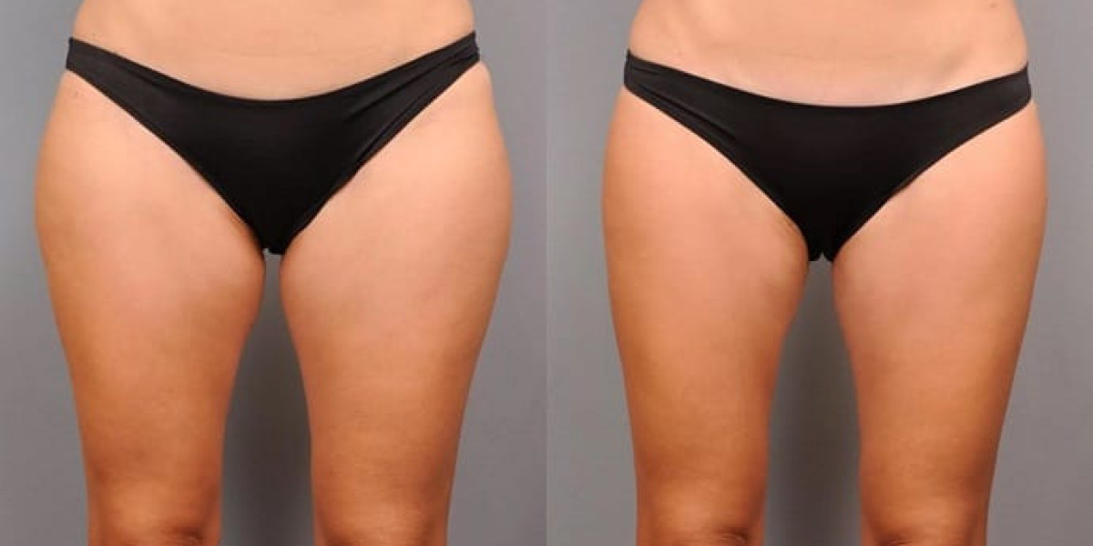 Thigh Skin Rejuvenation with J Plasma in Dubai: Modern Skin Tightening Solutions for Smoother Legs
