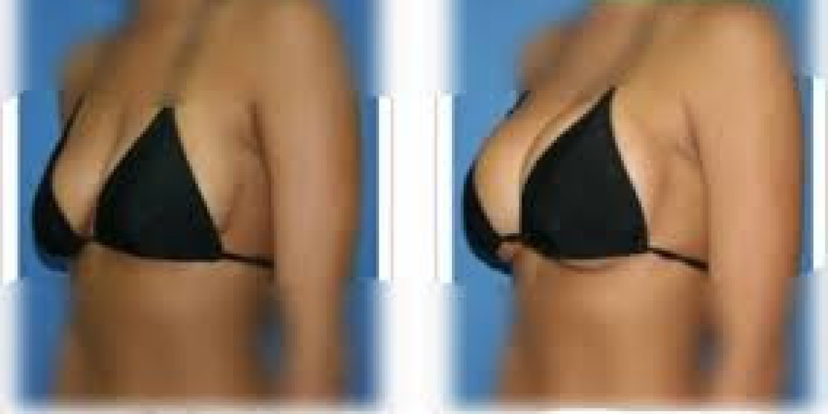 Advanced Breast Enhancement Procedures in Dubai: Modern Options for Natural and Balanced Results