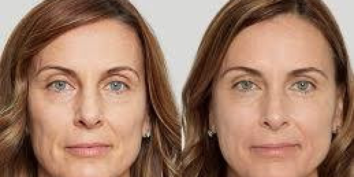 Top-Rated 8-Point Facelift Treatments in Dubai for Natural Facial Rejuvenation