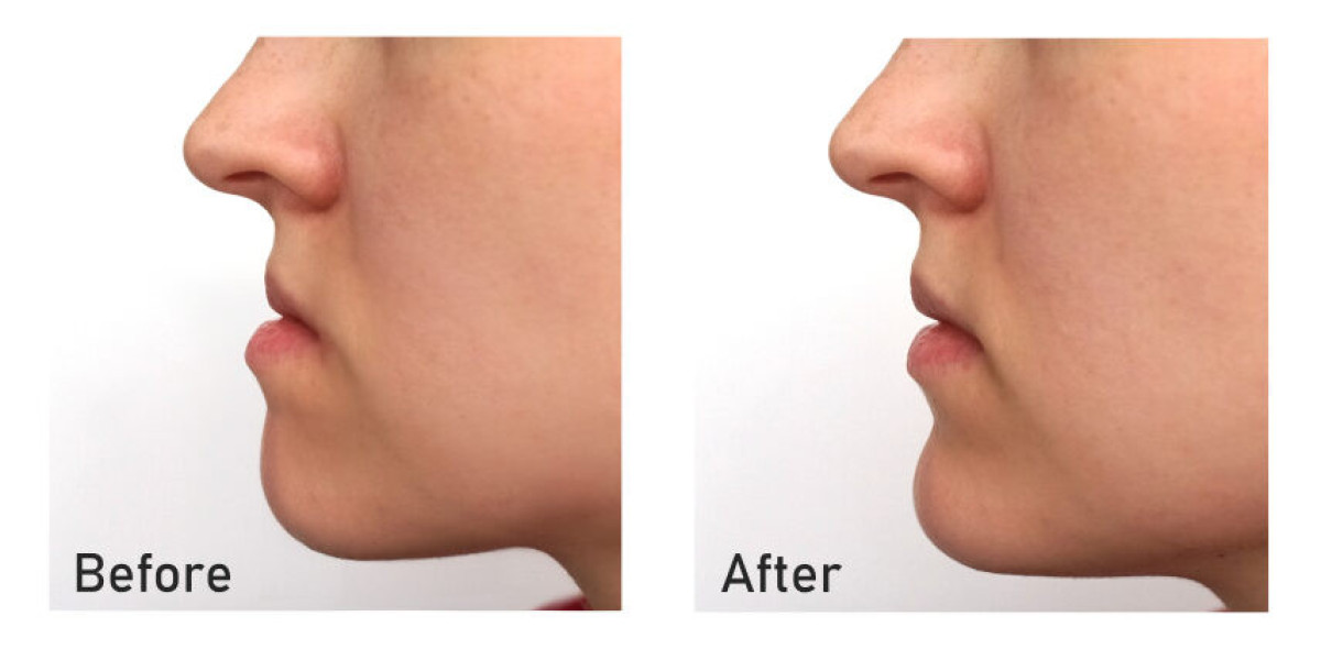 Jaw Surgery Patient Reviews: Islamabad Edition