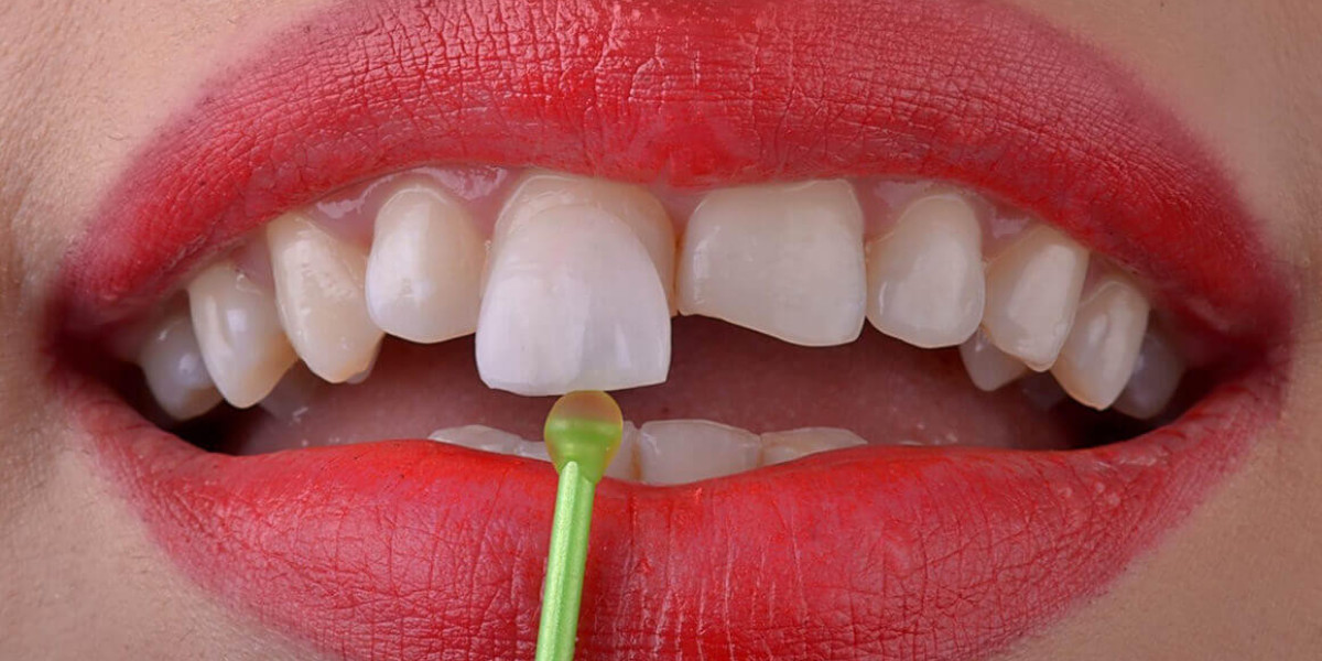 E-Max Veneers smile refinement designed for lasting beauty