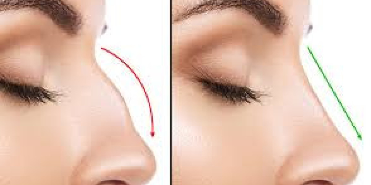 Dubai Cosmetic Surgery Centers Offering Rhinoplasty Procedures