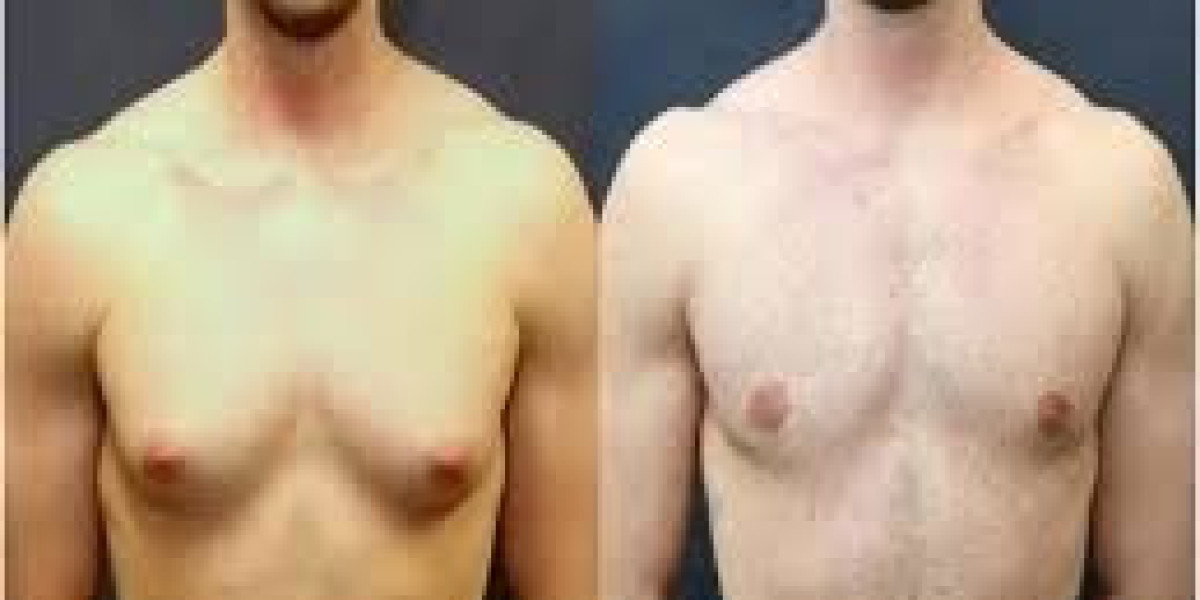 Male Chest Contouring Surgery in Dubai – A Complete Guide to a More Defined Chest