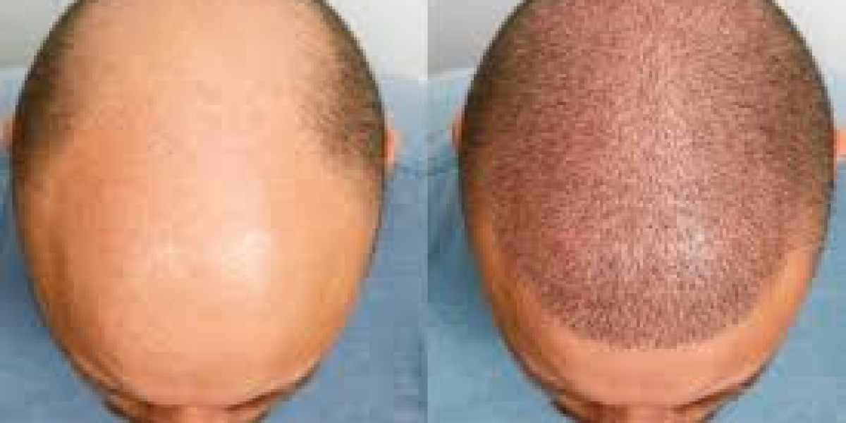 Hair Transplant Clinics with International Standards in Dubai: What to Expect and How to Choose the Right Care