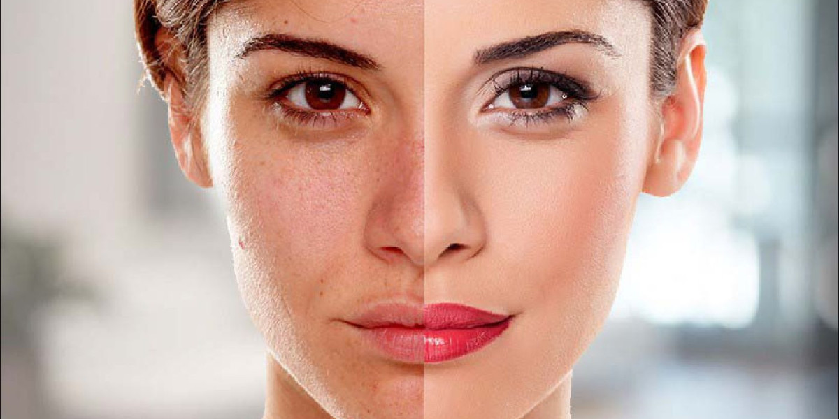 Achieve Radiant Skin with Safe Skin Whitening in Islamabad for Sensitive Skin