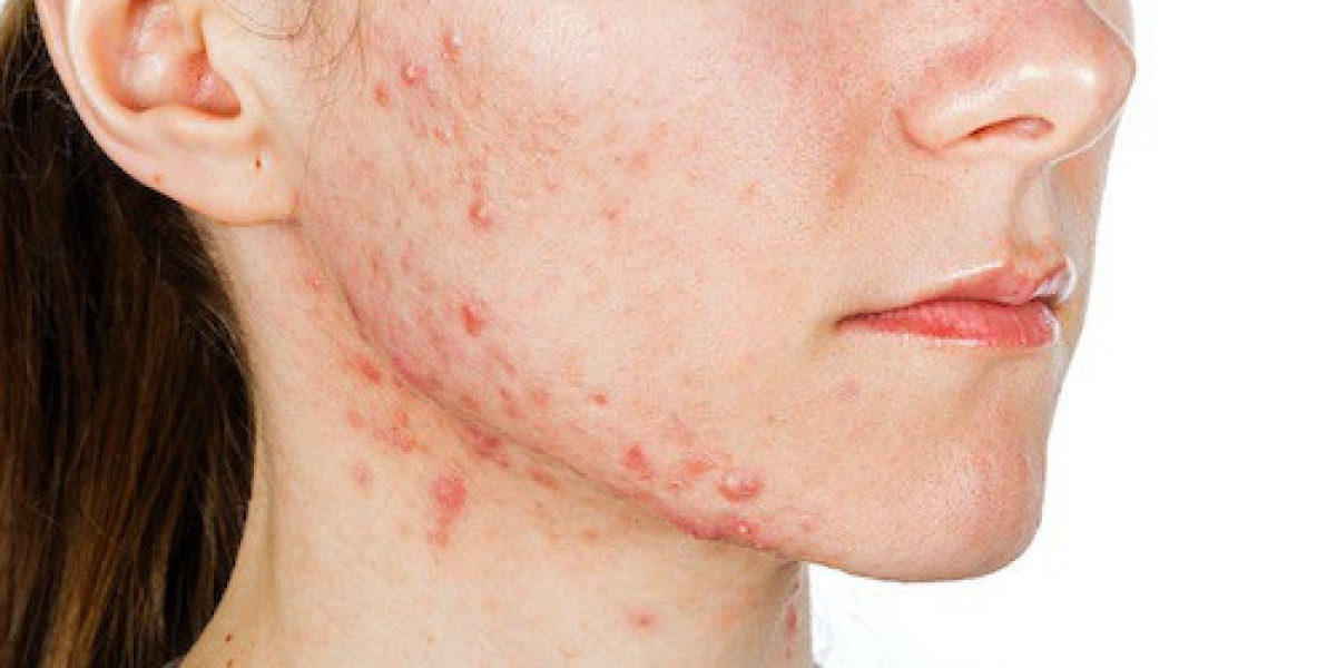 Why Acne Treatment in Dubai Is Worth Trying