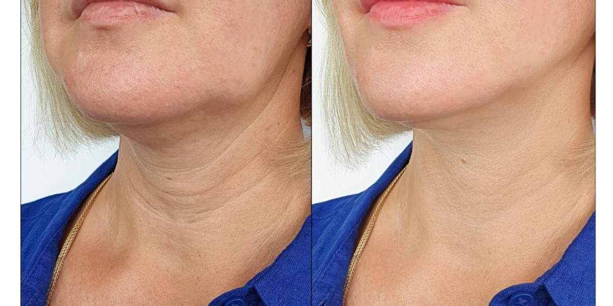 Botox for Jawline Contouring with Allergan in Dubai | Non-Surgical Facial Slimming Guide