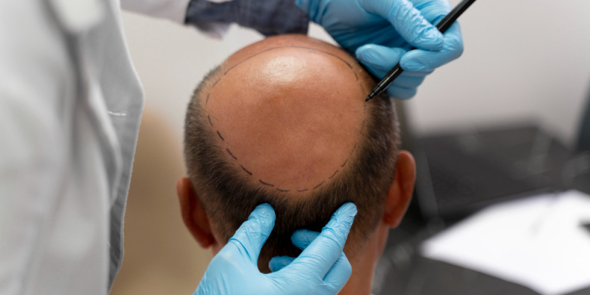 Global Hair Restoration Market Size, Trends, and Growth Forecast 2026-2033