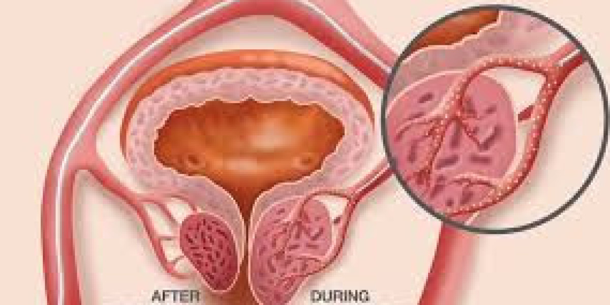 Minimally Invasive Enlarged Prostate Treatment Explained