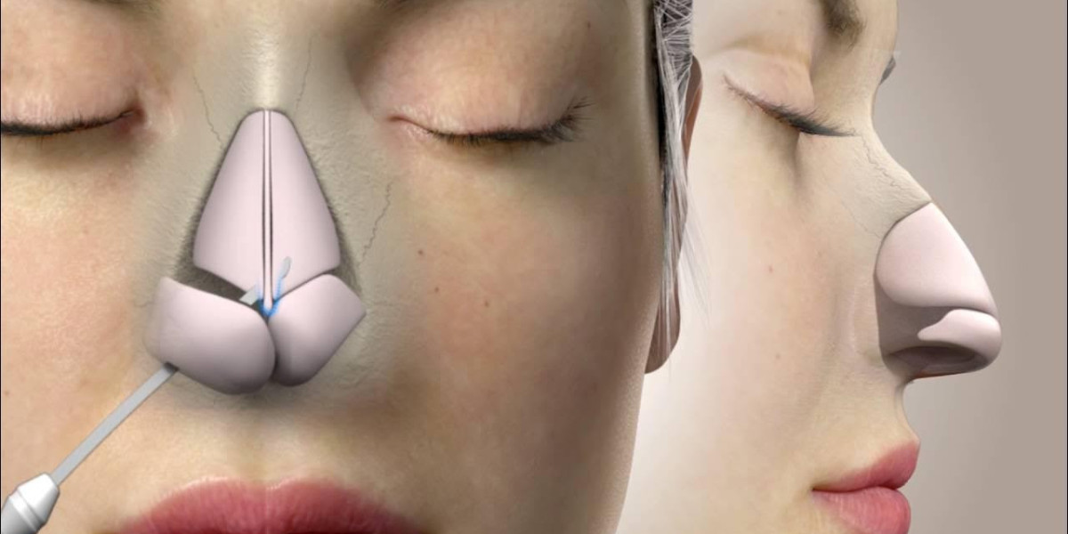 Non-Surgical Rhinoplasty Explained for First-Timers
