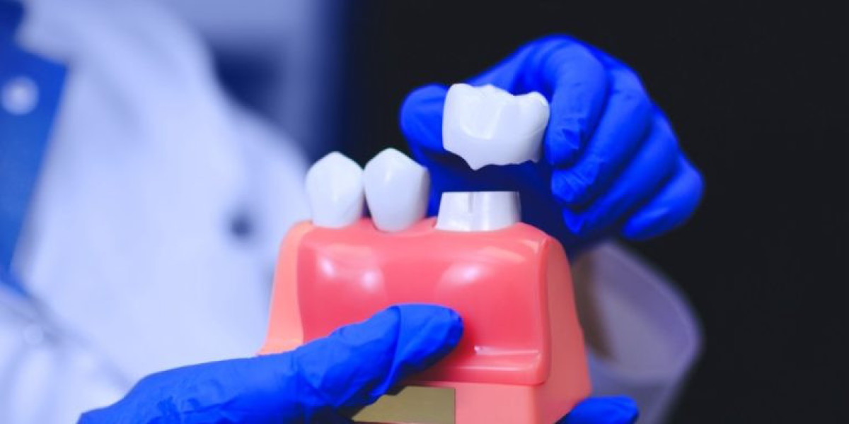 Dental Implants Norcross: A Long-Lasting Solution for Missing Teeth at Berkeley Lake Dental