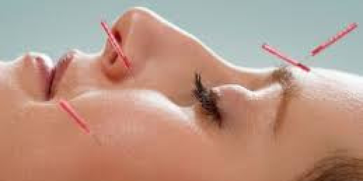 Holistic Wellness Through Acupuncture Treatment in Dubai for Natural Balance and Healing