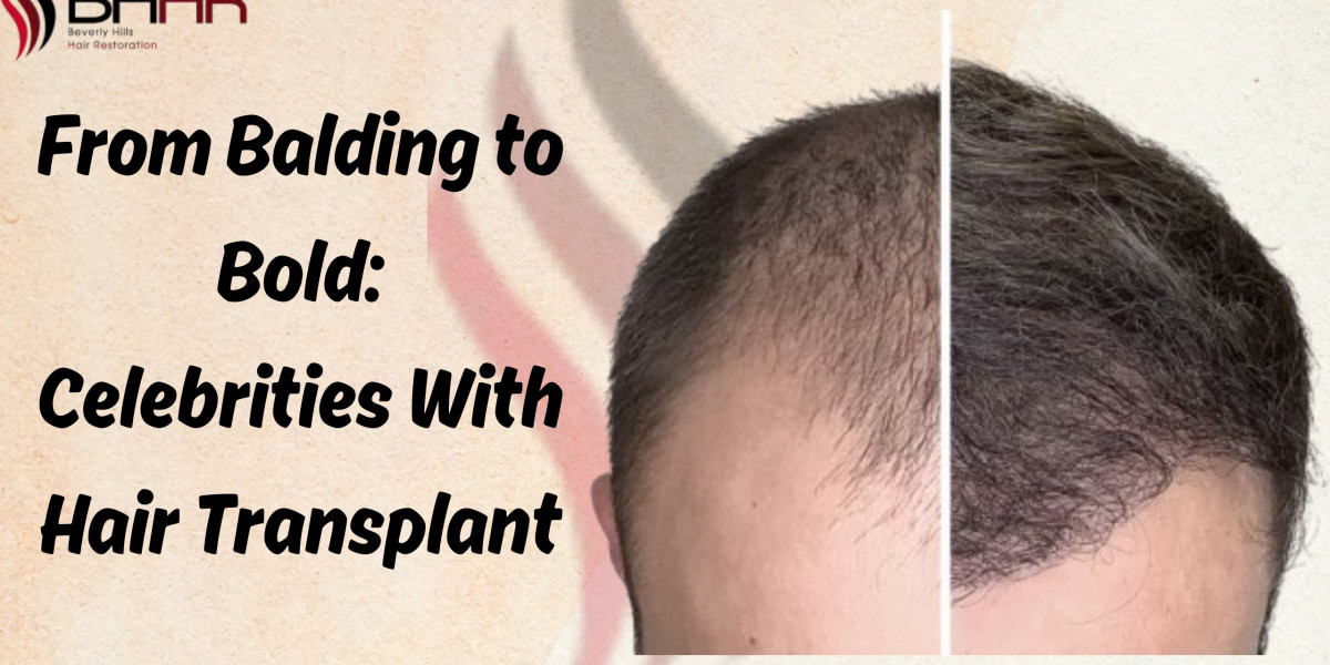 From Balding to Bold: Celebrities With Hair Transplant