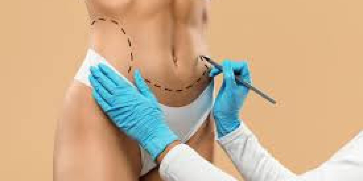 Understanding the Process of Liposuction Surgery in Dubai: Step-by-Step Guide