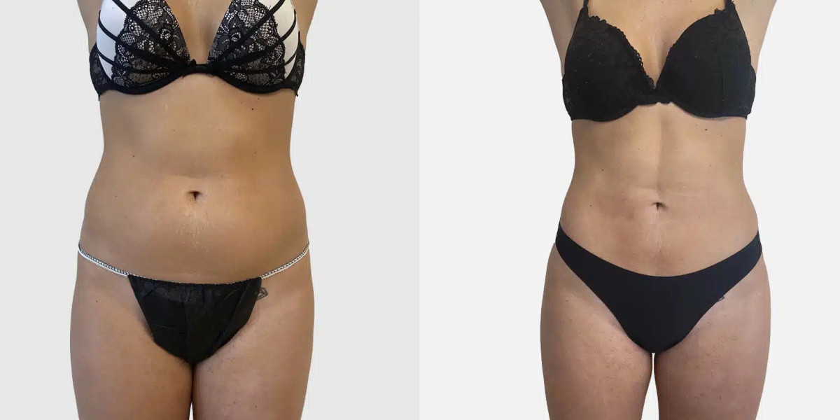 Vaser 4D Liposuction Cost Explained for Beginners