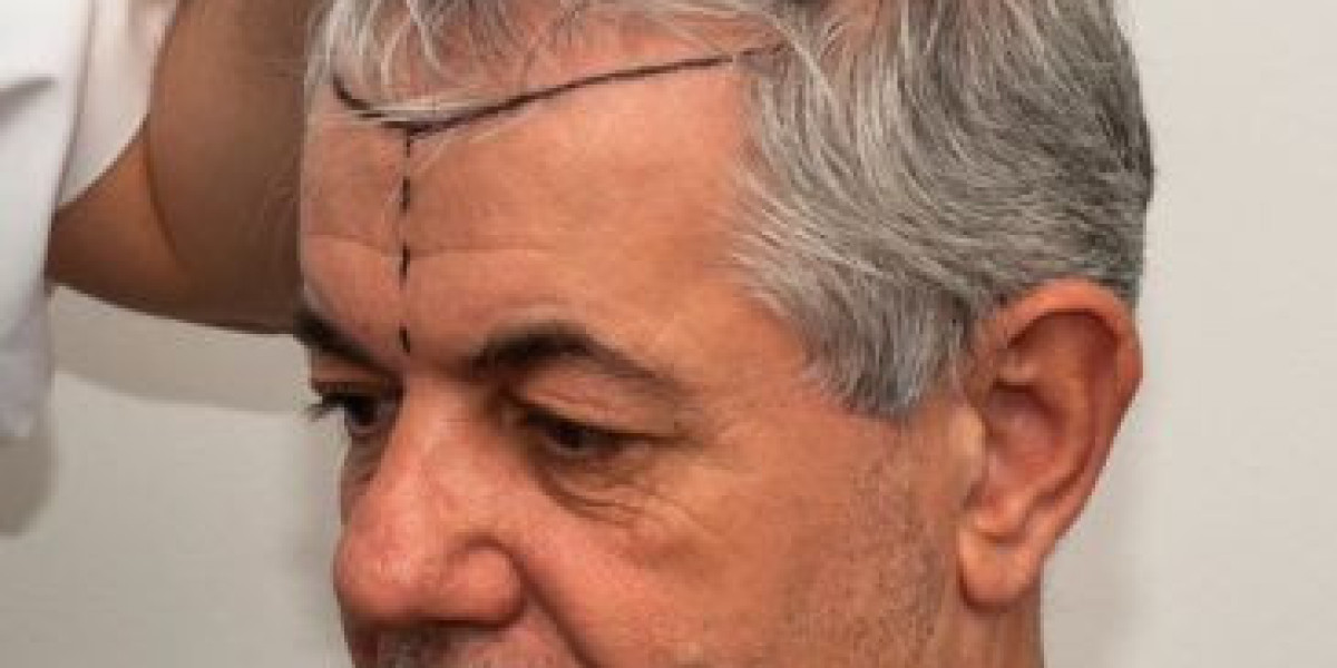 Hair Transplant in Dubai for Hair Follicle Strengthening Treatment