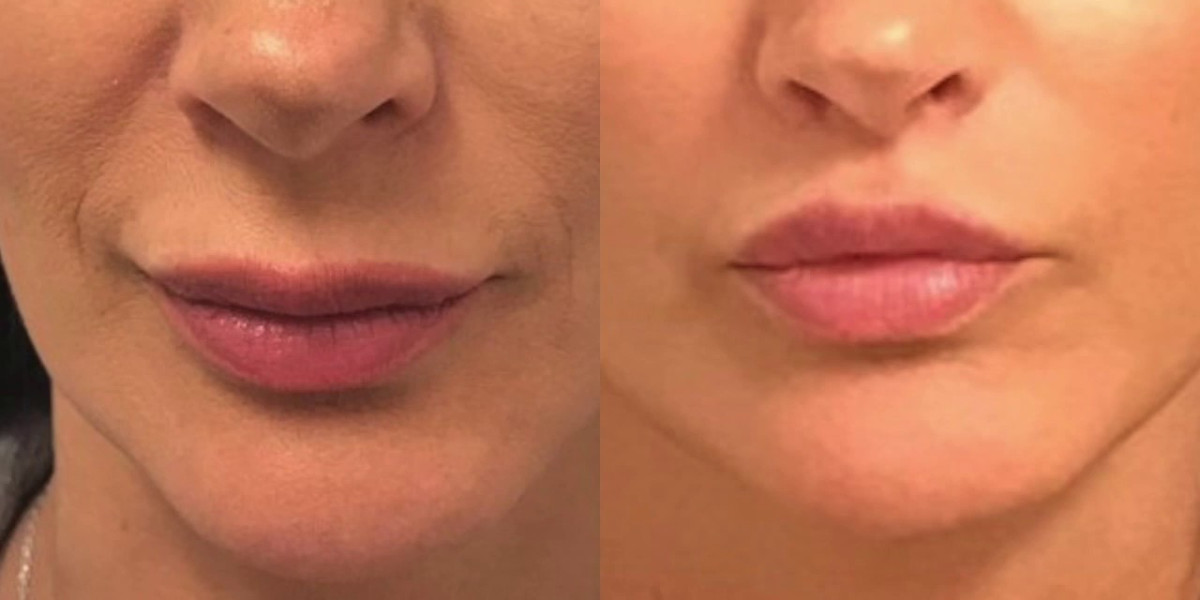 Why Riyadh is Becoming a Hub for Advanced Cosmetic Lip Surgery