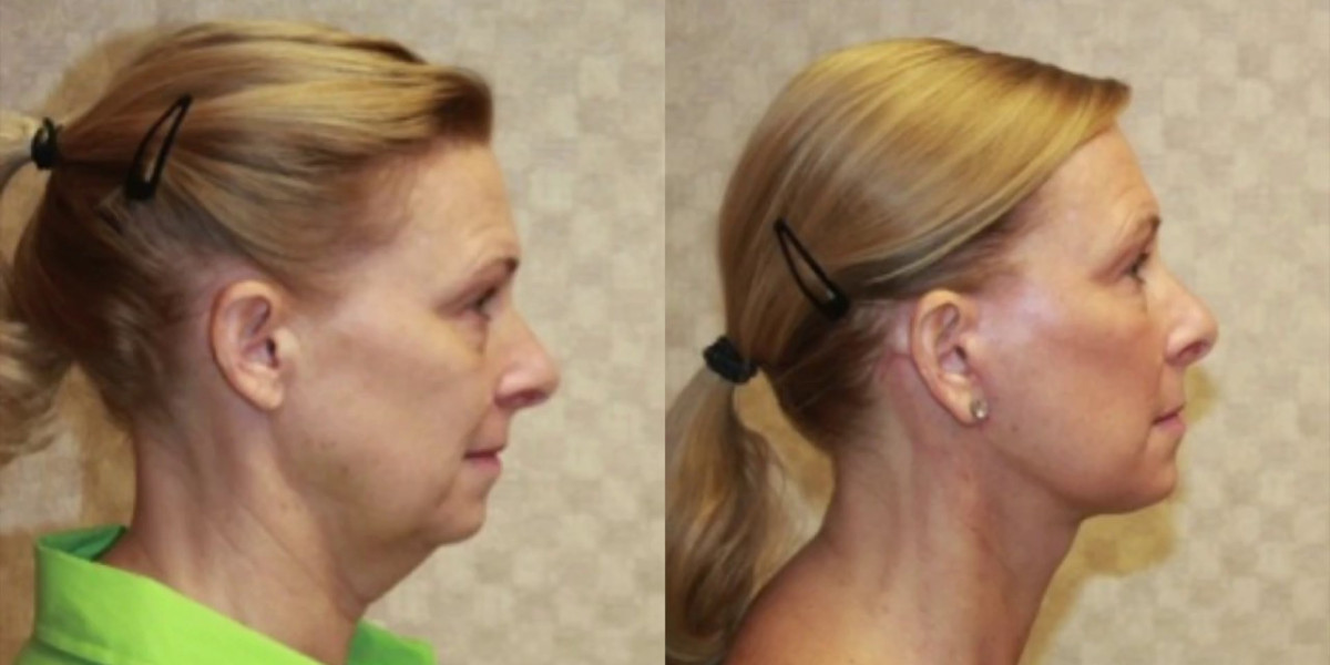 Neck Lift Surgery in Dubai Safety and Modern Methods Guide