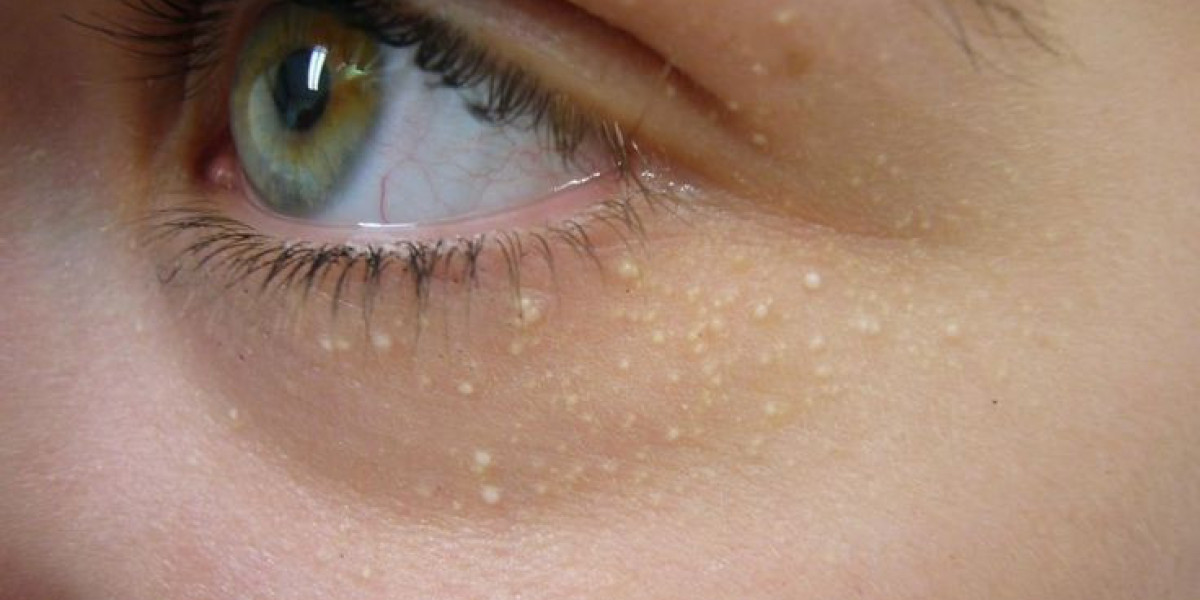 Is Milia Treatment the Smart Choice for Smooth Skin Results?