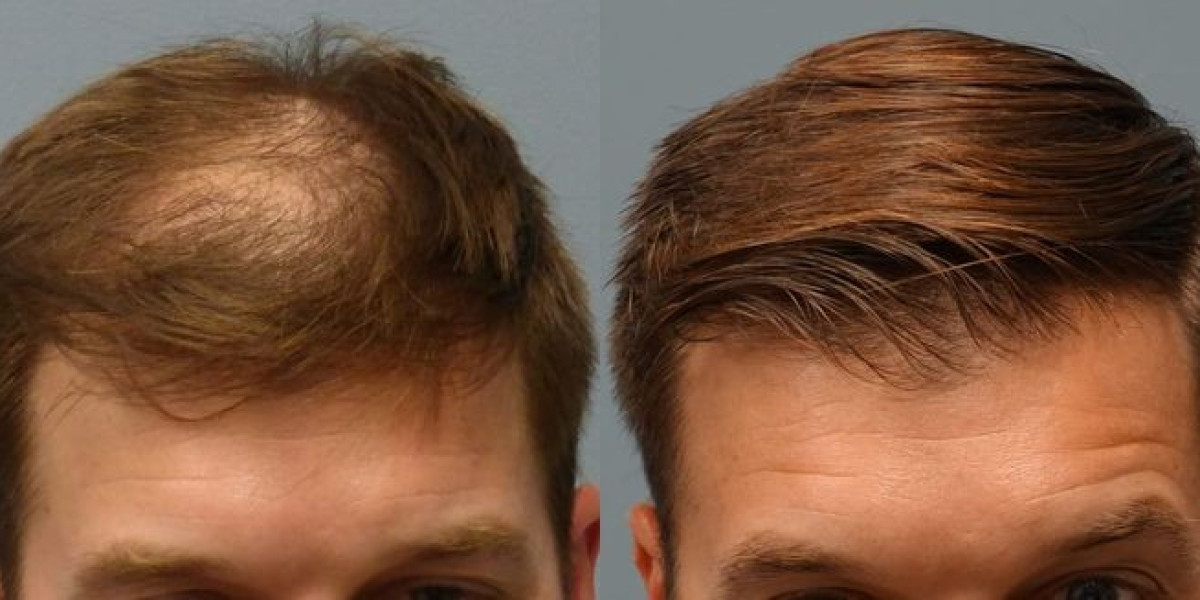Hair transplant in Dubai Graft Survival and Success Rate