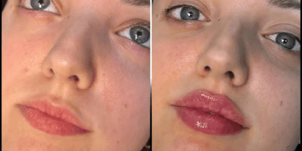 Fillers in Dubai: Understanding the Different Types