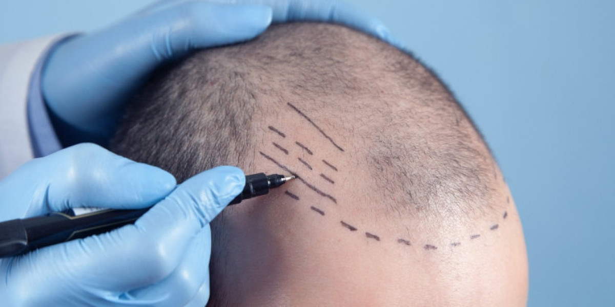 زراعة الشعر في الدمام لتحقيق مظهر أكثر كثافة