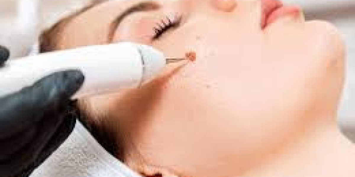 Mole Removal in Dubai Using Modern Technology Guide