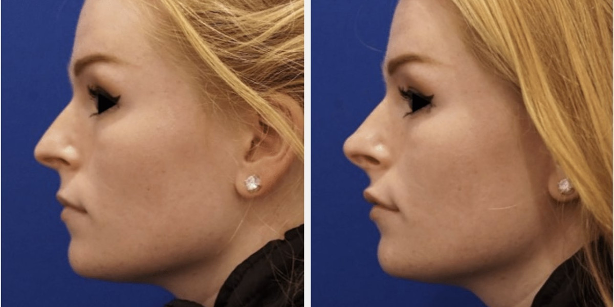 Liquid Rhinoplasty in Dubai Before and After Insights