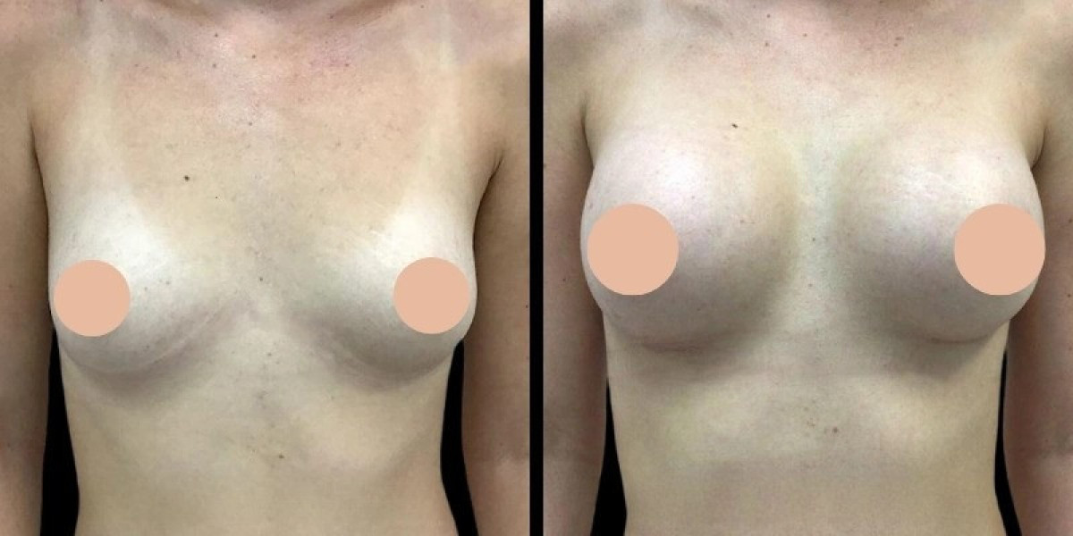 Best Doctors in Dubai for Breast Augmentation: A Complete Patient Guide