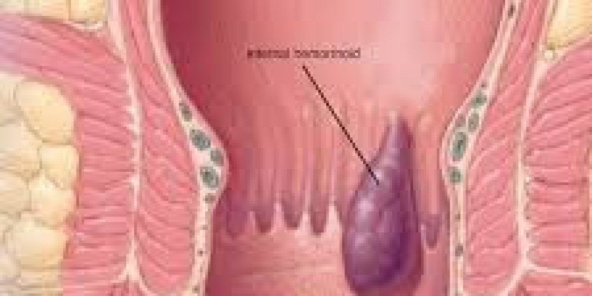 Advanced Techniques Used for Haemorrhoids Treatment in Dubai: Modern Solutions for Better Comfort