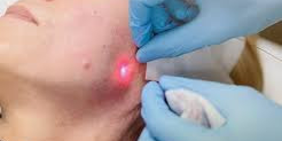 Endolift in Dubai: A Safe Alternative to Surgical Facelift