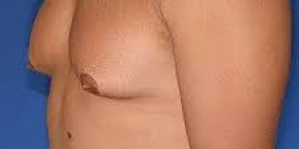 Gynaecomastia Surgery in Dubai: Step-by-Step Guide