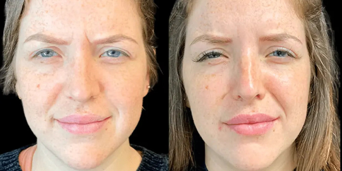 How Botox in Dubai Can Create a More Youthful Appearance
