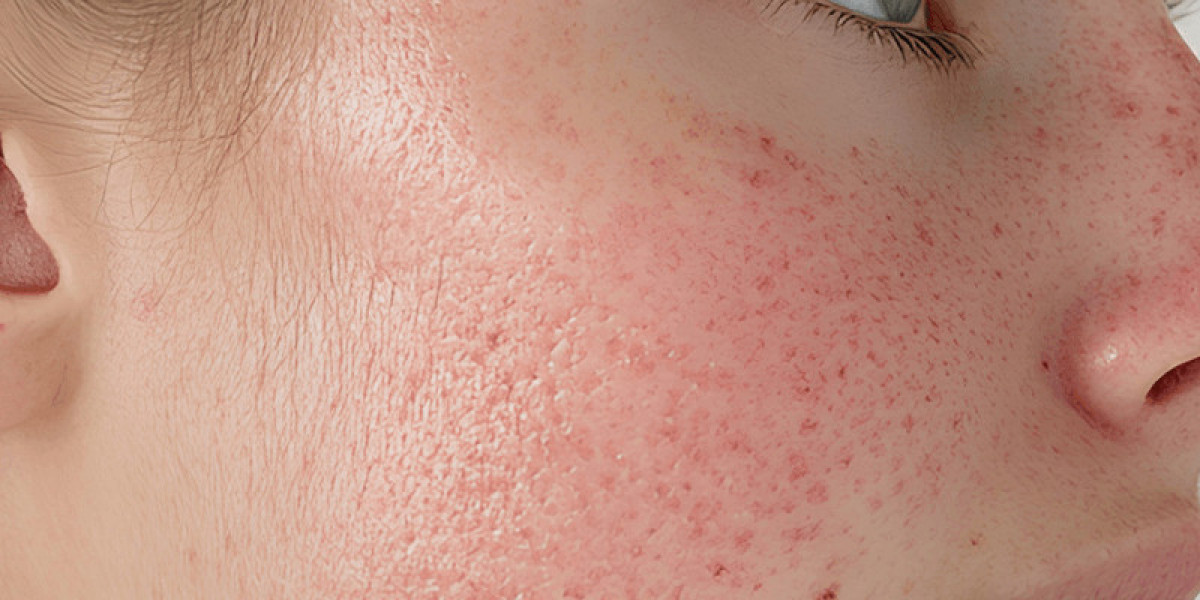Can Dry Skin Have Large Pores?