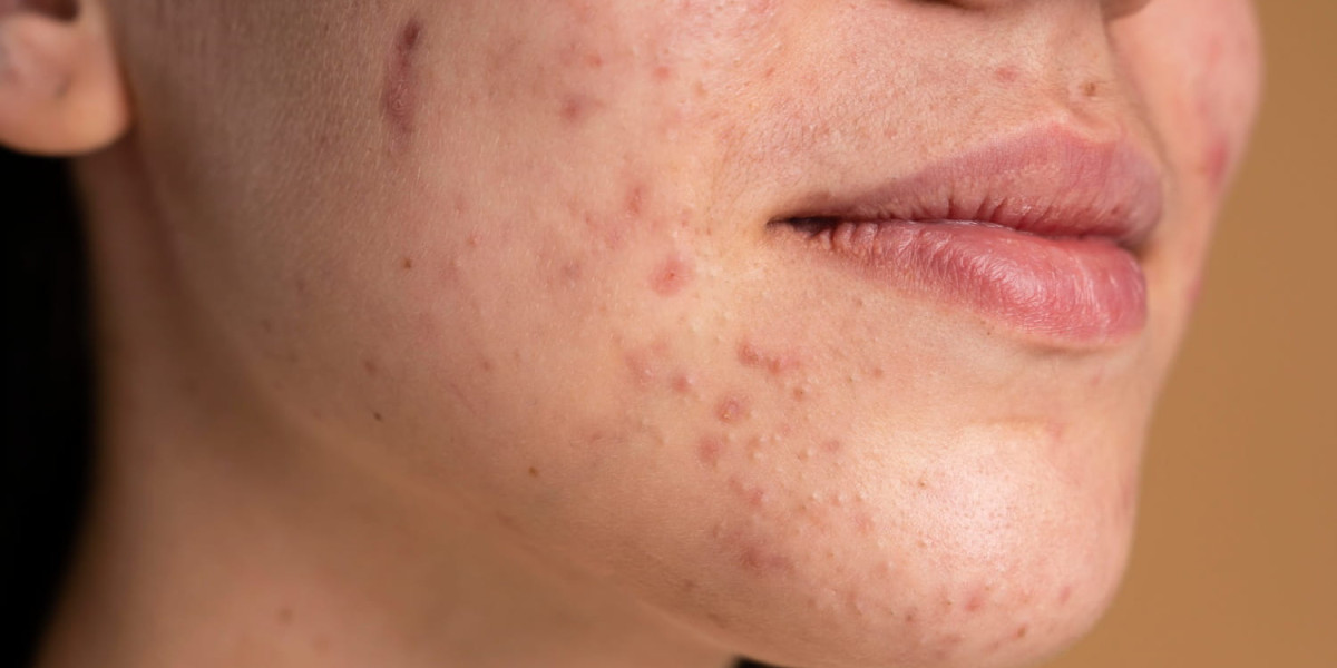 What Causes Acne and How Can It Be Effectively Treated?