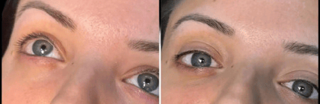 dermal fillers Cover Image