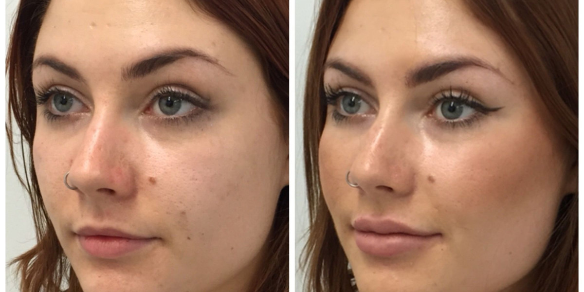 The Evolution of Cheek Contouring: Modern Techniques in Riyadh